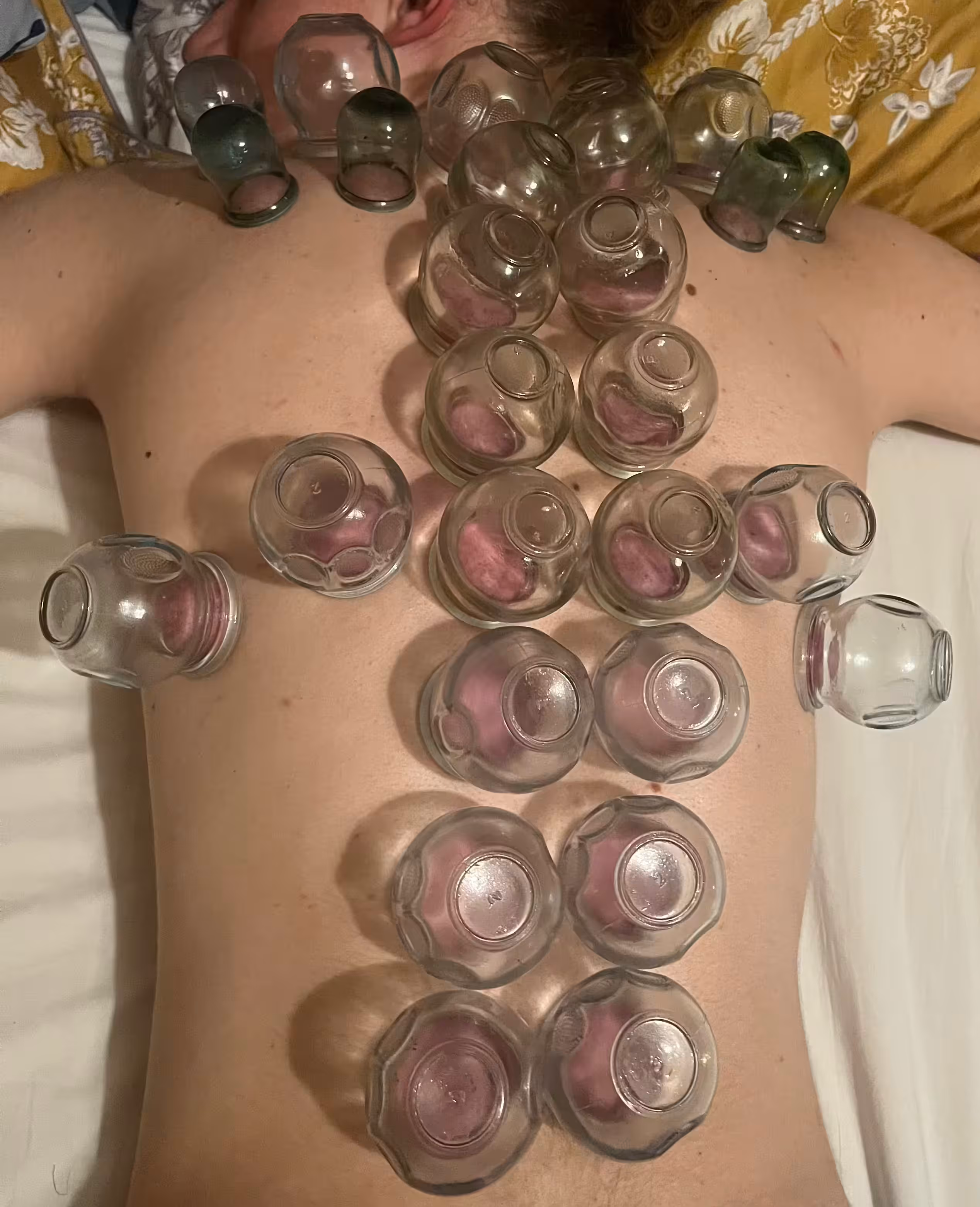 Cupping session